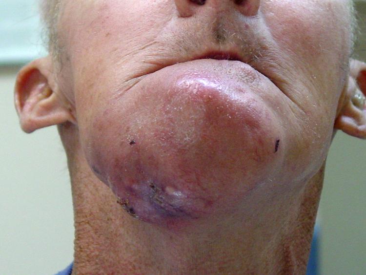 Oral Cancer Eroding Through Facial Skin(Jaw)