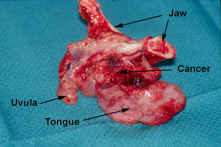 Commando Operation - Jaw, Tongue and Neck Operation -- Surgical Specimen