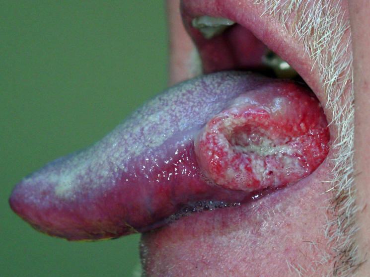 Large lateral tongue cancer caused by the human papilloma virus, hpv.